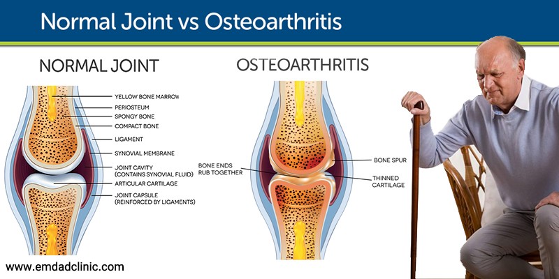 بیماری آرتروز یا استئوآرتریت درسالمندان و علائم آن