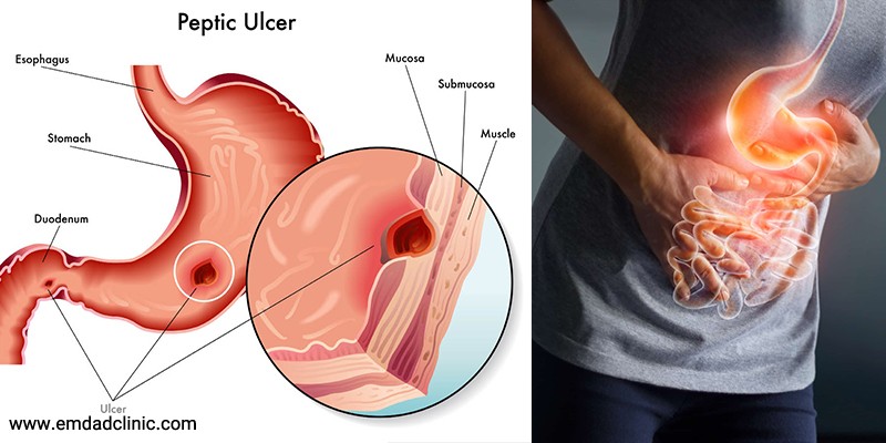 زخم معده چیست و برای سالمندان مبتلا به زخم معده چه باید کرد؟
