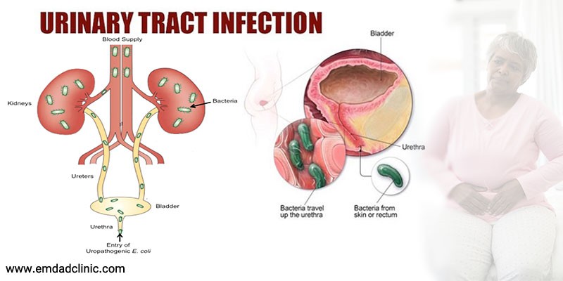 عفونت ادراری در سالمندان