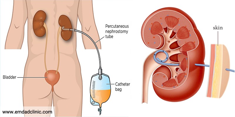 نفروستومی چیست؟ مراقبت از نفروستومی چگونه است؟