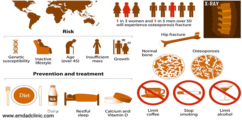 پوکی استخوان چیست؟(عامل پوکی استخوان وپیشگیری از آن)