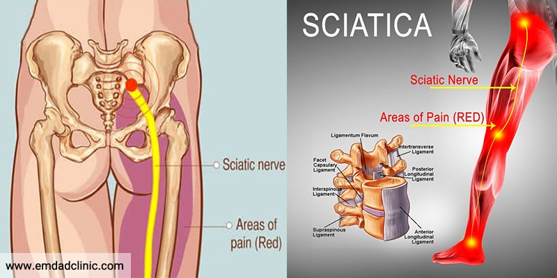 سیاتیک چیست؟ علائم و راه های پیشگیری از آن -2