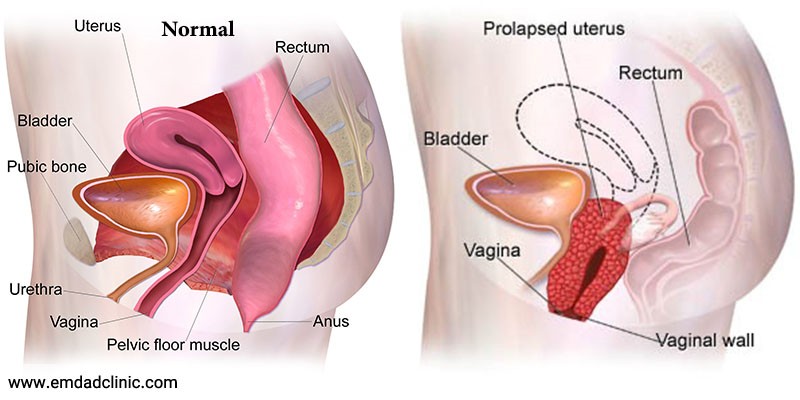 پرولاپس یا بیرون زدگی اعضای لگن در بانوان